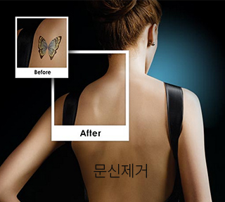 문신제거